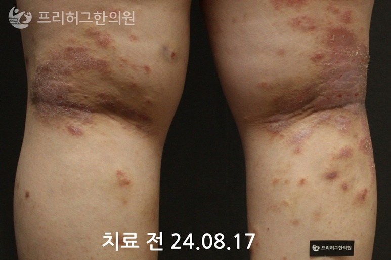 구로아토피1_7ab2a7fe304e3cf3923e2d1bae37139e.jpg