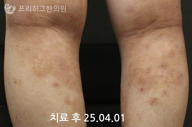 구로아토피2_113be353cff40e41d904cee2c9ff48c9.jpg