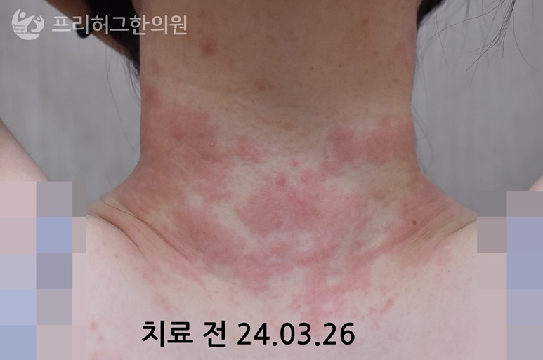 구월동두드러기1_801ab2915c8c19f6e335147af07b5f82.jpg