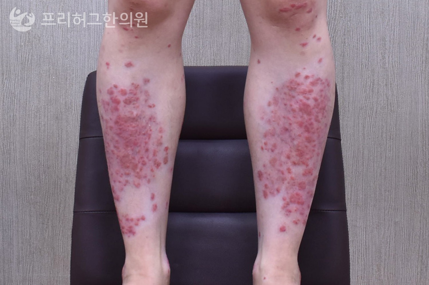 치료_전_19988cba6b8d4fb589307139724c464d.jpg