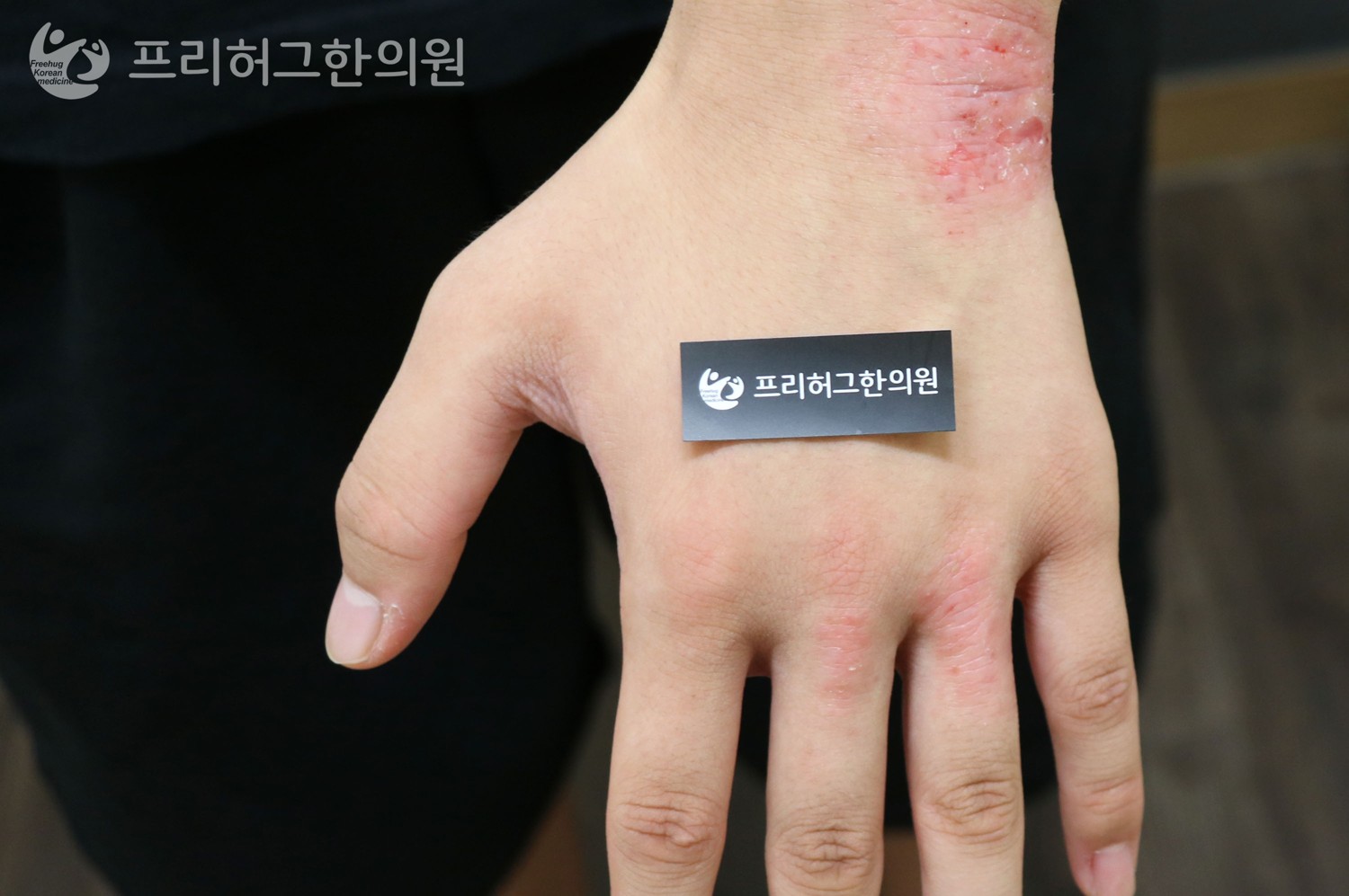 치료_전_a8c58246585325654db970d5fe2a3b60.jpg