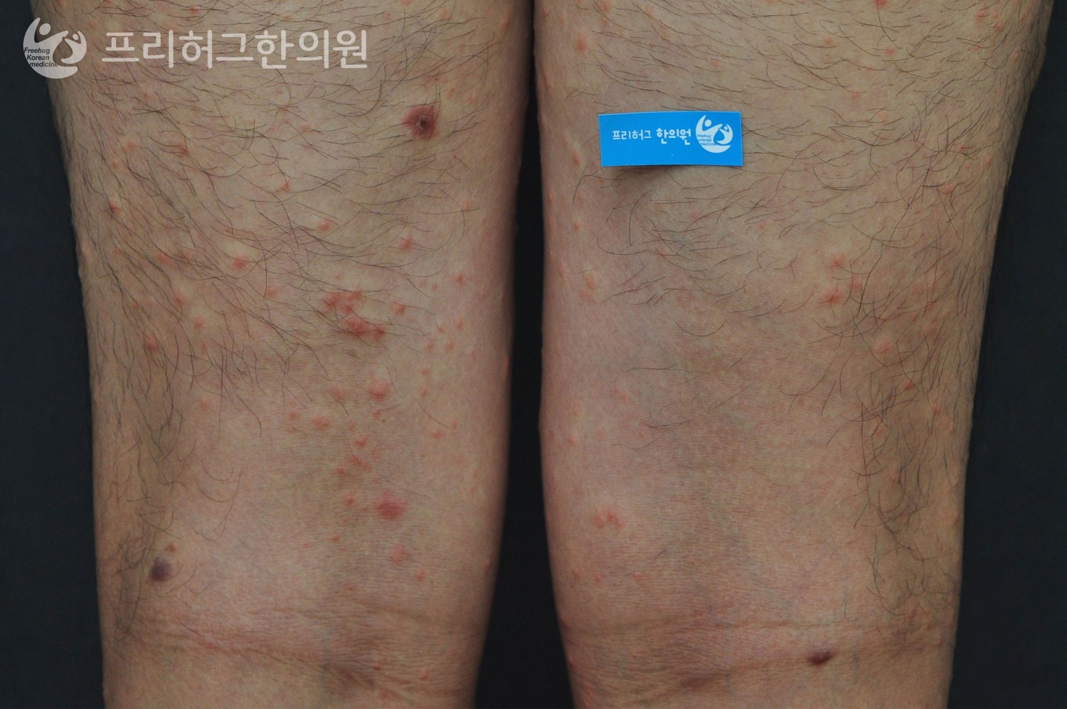치료_전_f2e9f078a48107b6388a144840536639.jpg