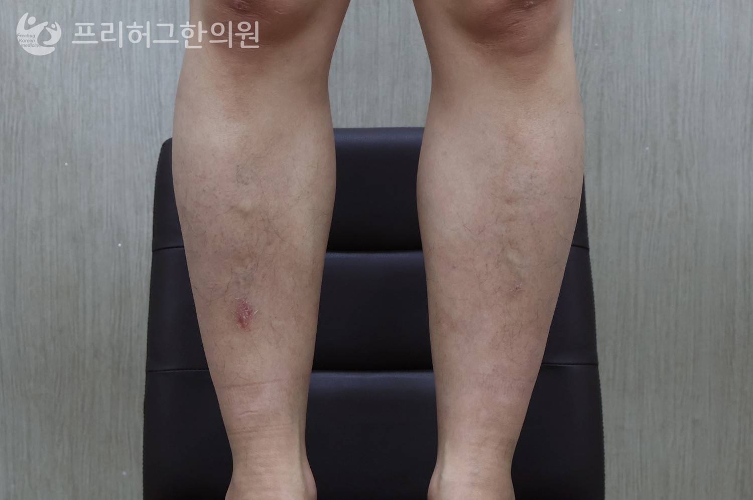 치료_후_205292ee86960d638d0e747709fcf86c.jpg
