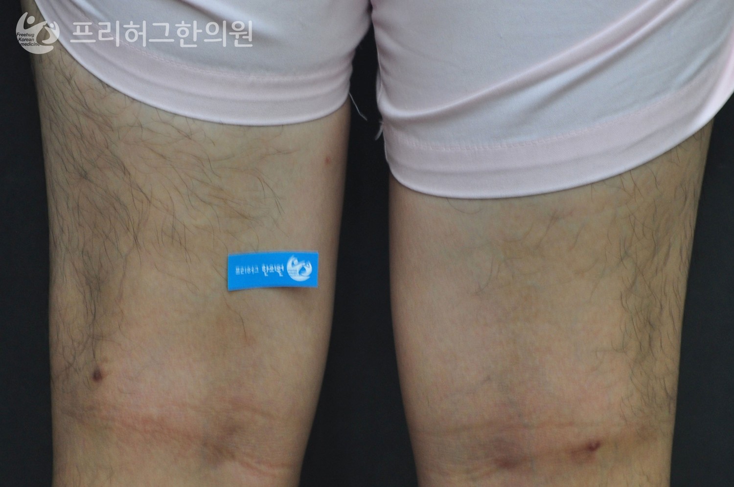 치료_후_cf4d5e53b985c133e754a4fb916d1b96.jpg