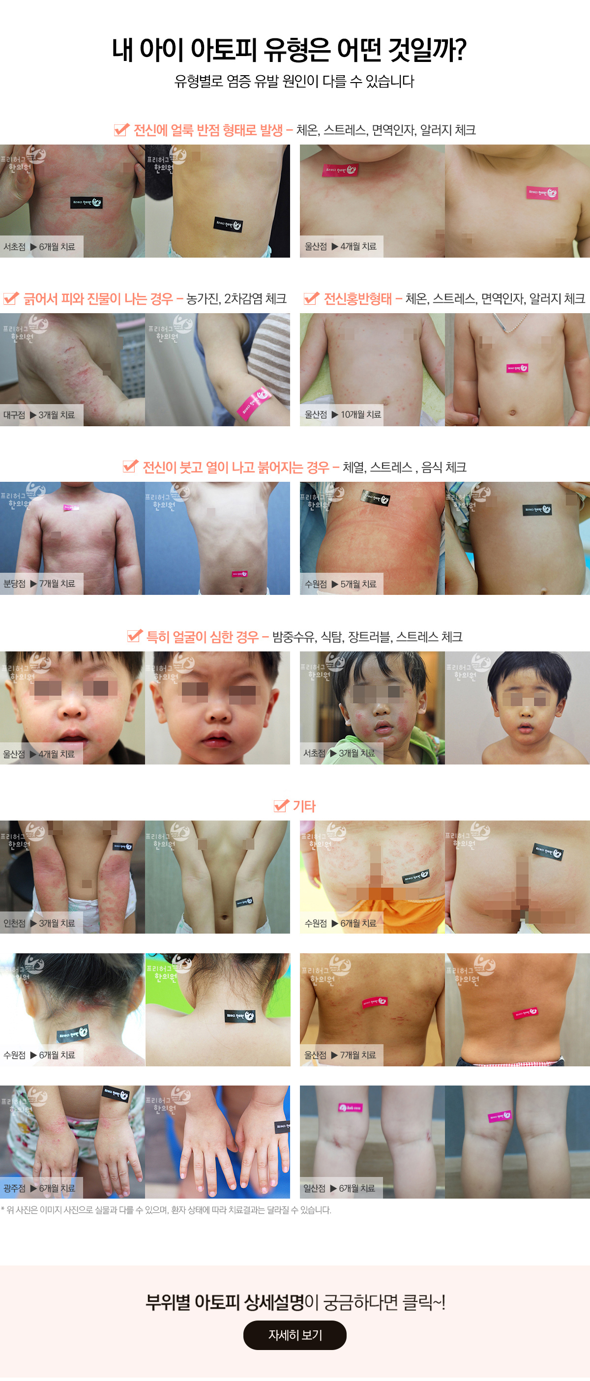 내 아이 아토피 유형은 어떤 것일까?