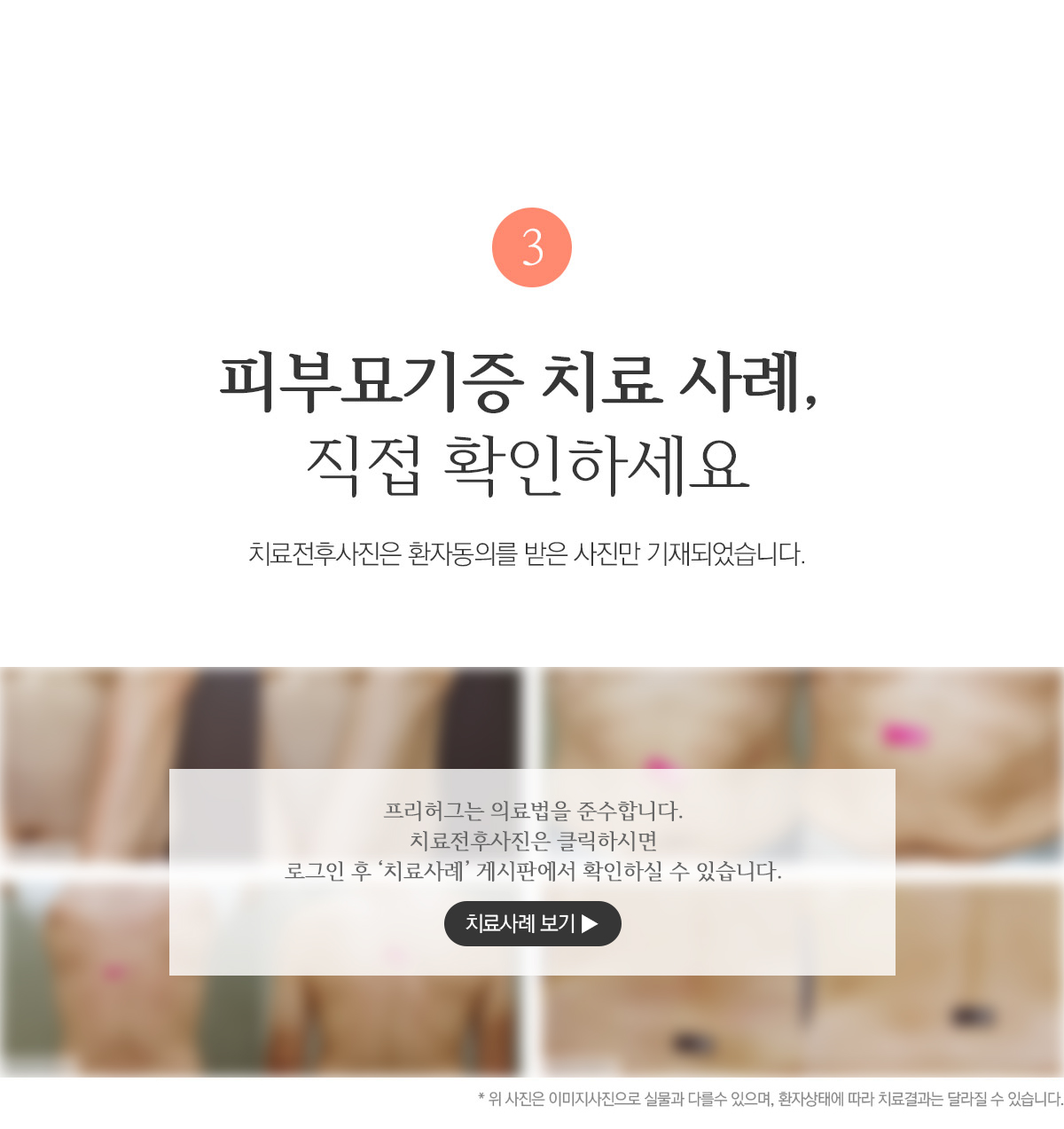 피부묘기증 치료 사례, 직접 확인하세요