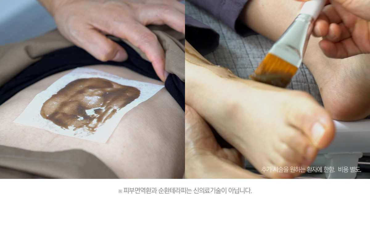 유두습진 치료, 먹으면서 간편하게 순환테라피