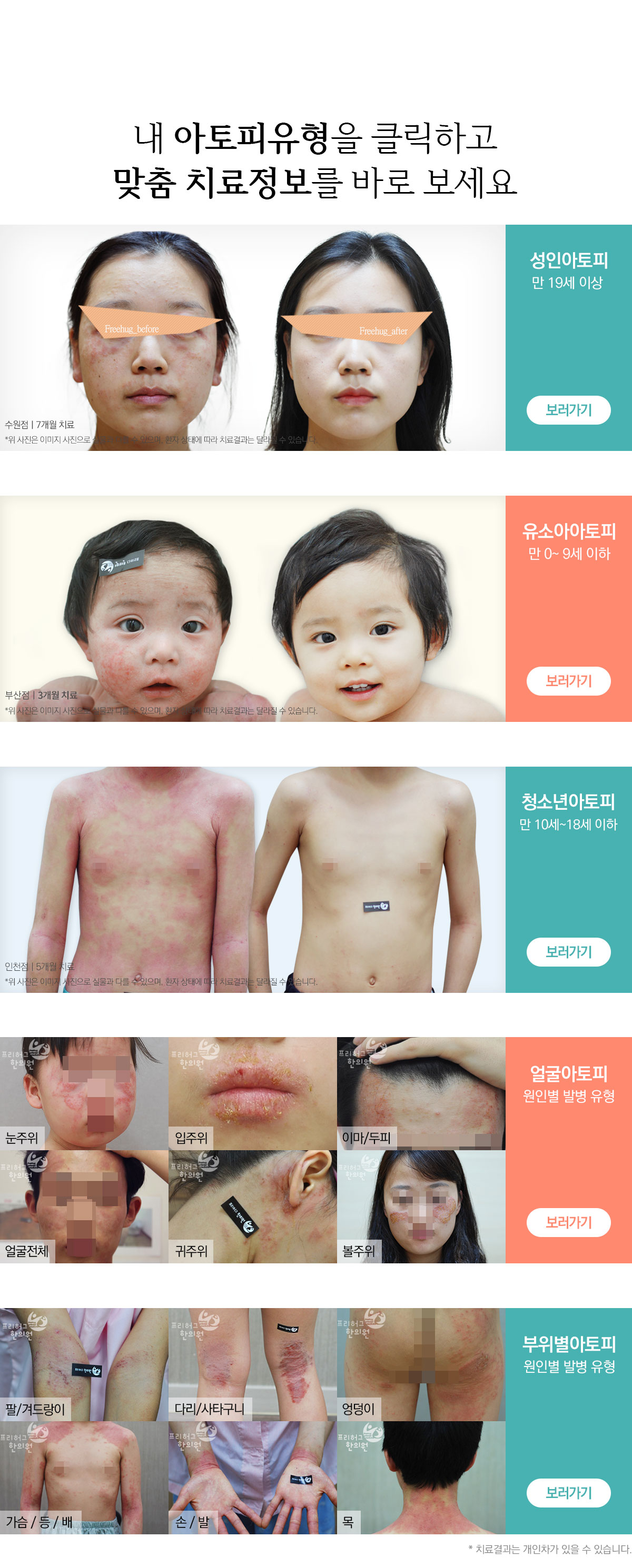 내 아토피유형을 클릭하고 맞춤 치료정보를 바로 보세요