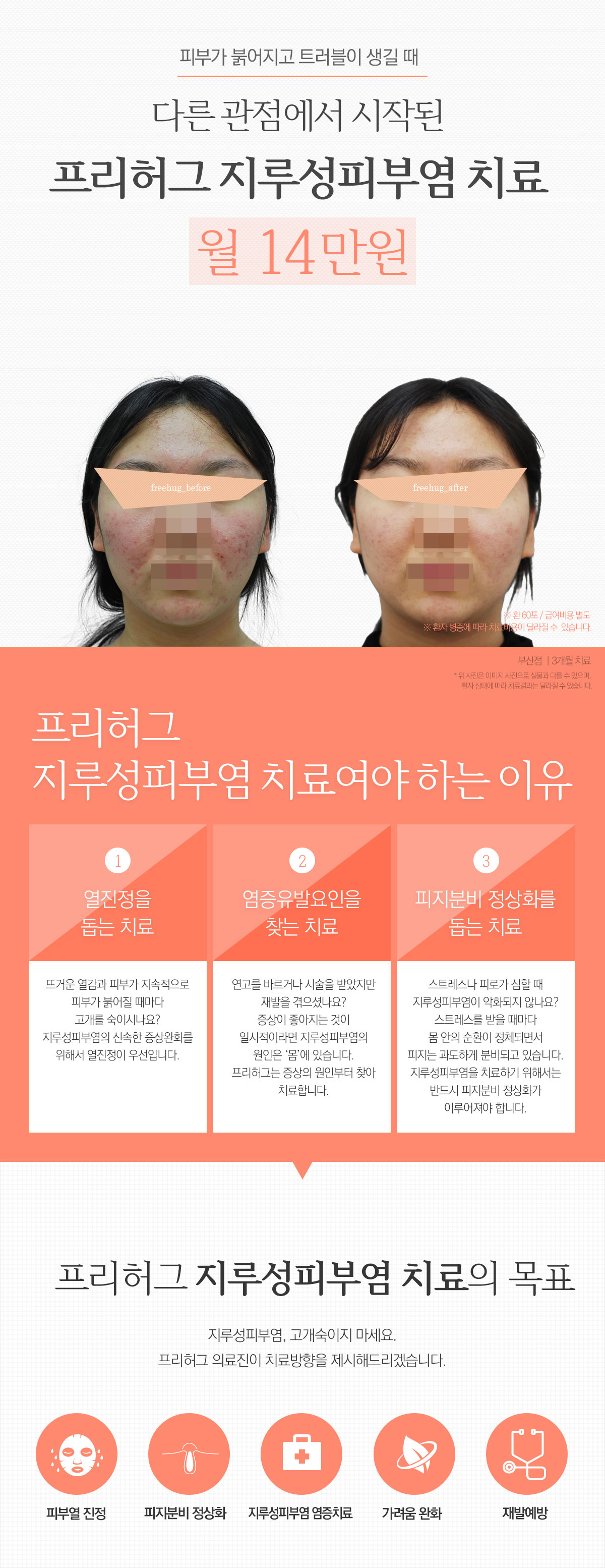 프리허그 지루성피부염 치료