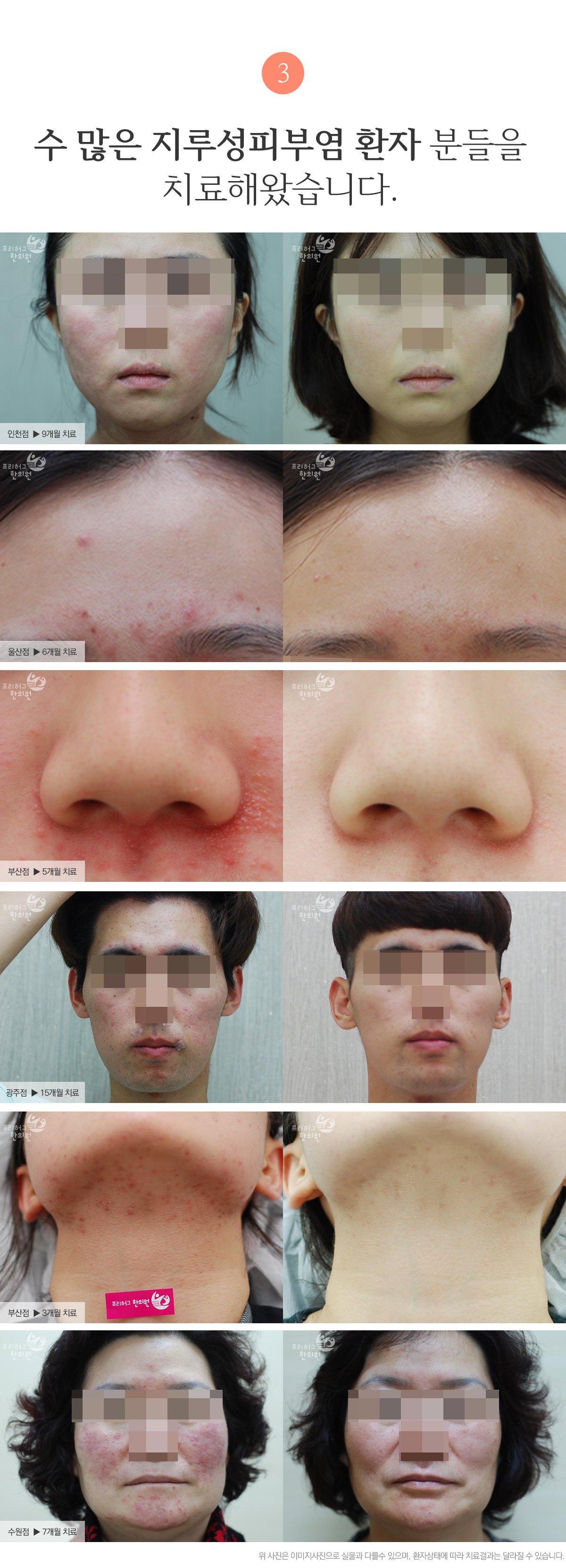 수 많은 지루성피부염 환자 분들을 치료해왔습니다